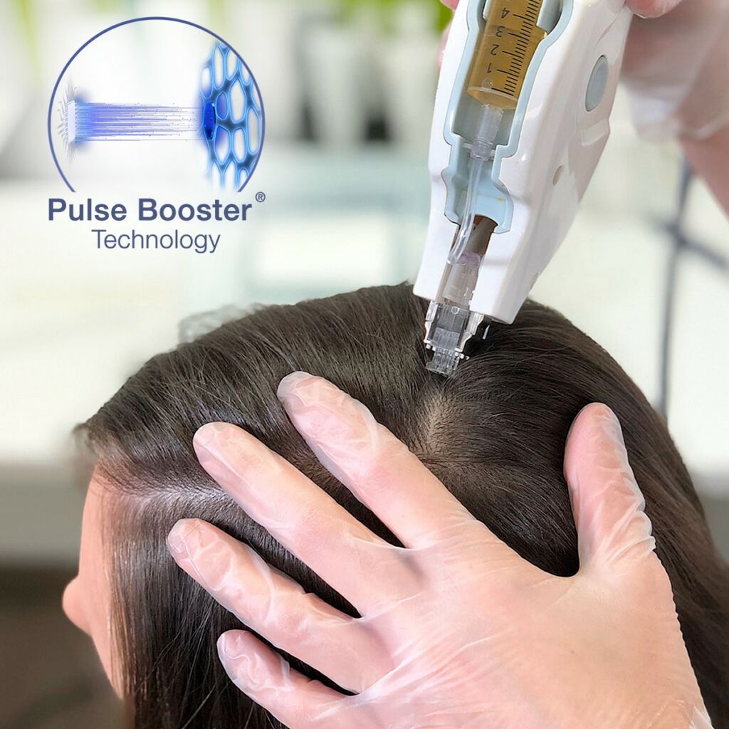Mesotherapie, Haarausfall, Glatze. Kreisrunder Haarausfall, Glatze, keine Haare, Mesoject Gun, nadellos, Toskani, Anti Aging, Ästhetische Kosmetik